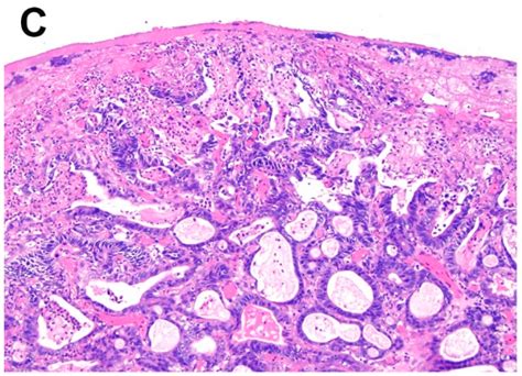 esophageal adenocarcinoma histology